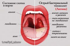Причины возникновения и лечение ангины