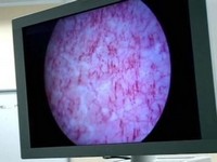 Цистит: народные методы лечения