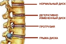 Симптомы и лечение межпозвоночной грыжи
