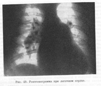 Легочно-сердечная недостаточность