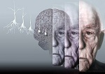 Новый метод диагностики болезни Альцгеймера 
