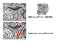 Рак предстательной железы прогноз