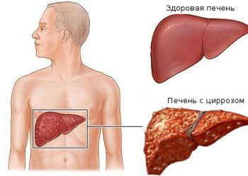 Вирусный гепатит С и его последствия