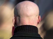 Лысые мужчины чаще болеют сердечными заболеваниями