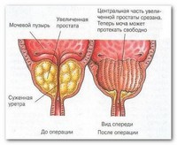 Аденома простаты: симптомы, лечение
