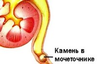 Застрял камень в мочеточнике?