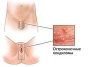 Остроконечные кондиломы у мужчин